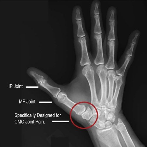 Comfort Cool Thumb CMC Restriction Splint. Patented Thumb Brace Provides Support and Compression. Helps with Arthritis, Tendinitis, Surgery, Dislocations, Sprains, Repetitive Use. Left Medium