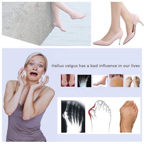 Askilt Bunion Corrector, Bunion Splints and Bunion Relief for Hallux Valgus, Big Toe Joint,Adjustable Bunion Splint Protector Sleeves kit F or Women and Men,7 pcs