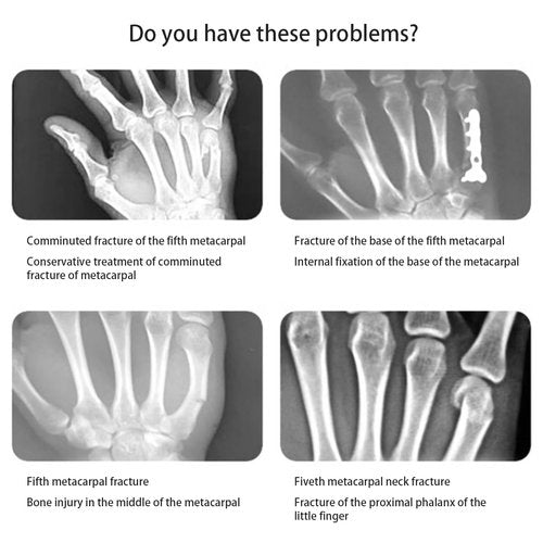Pinky & Ring Finger Splint Brace - Right Hand Brace Support for Boxer Fracture, Mallet Finger & Dislocation, Arthritis, Sprain, Broken, Little Finger Cast Immobilizer Straightener (4th/5th Metacarpal)