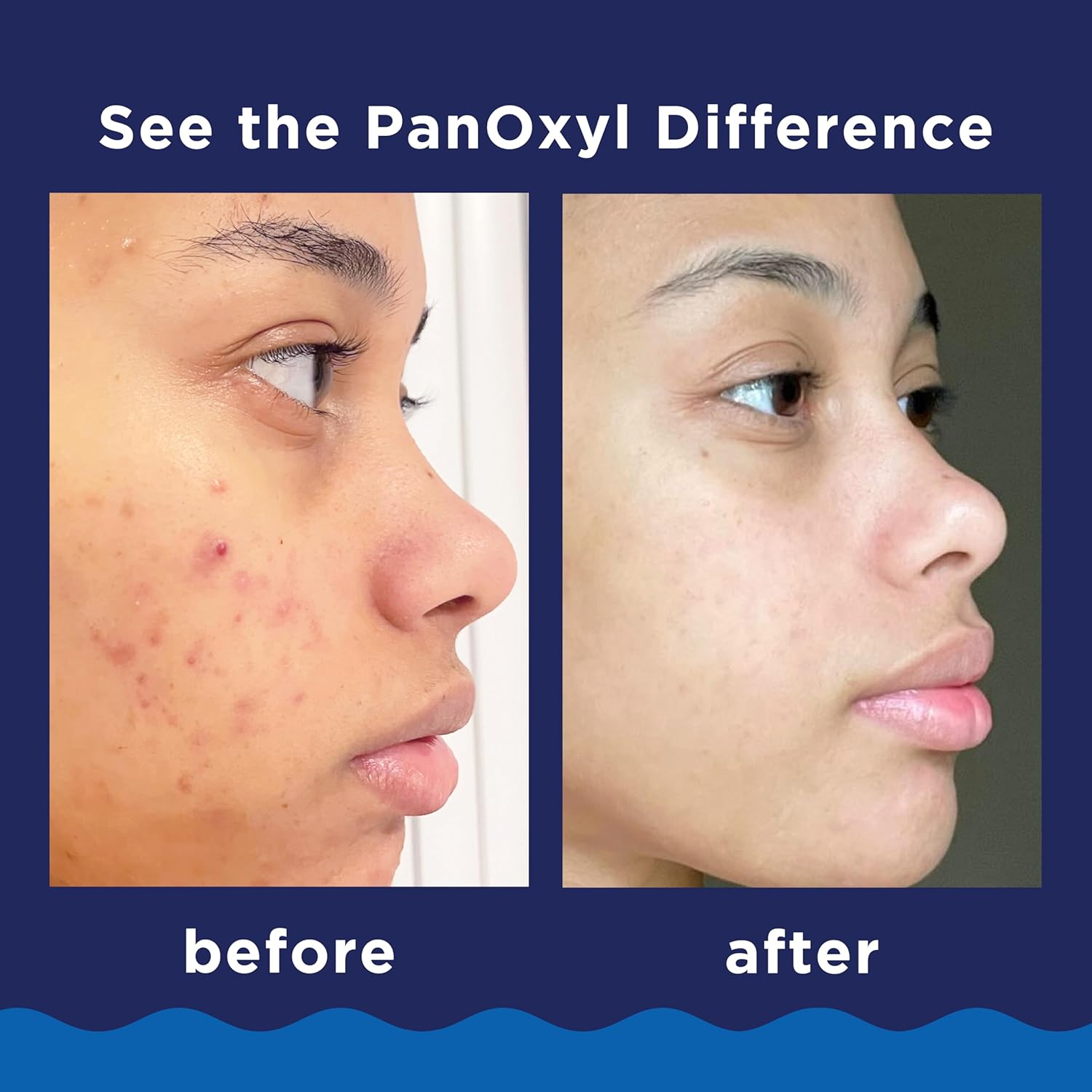 PanOxyl Acne Foaming Wash - Maximum Strength 10% Benzoyl Peroxide Cleanser | 5.5 Oz Tube for Clear Skin