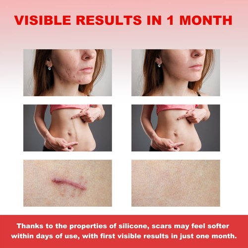 FRESINIDER Silicone Scar Sheets - Extra-Large 5.9"x2.4" for Enhanced Coverage | Pack of 8 for Effective Scar Treatment