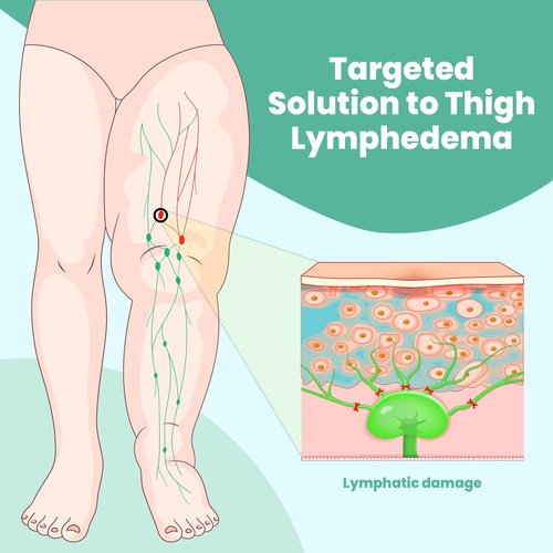 iDonua® Swollen Thigh Compression Wrap Brace for Lymphedema Reduction - with Adjustable 4 Cross Straps‌ (Short-L)