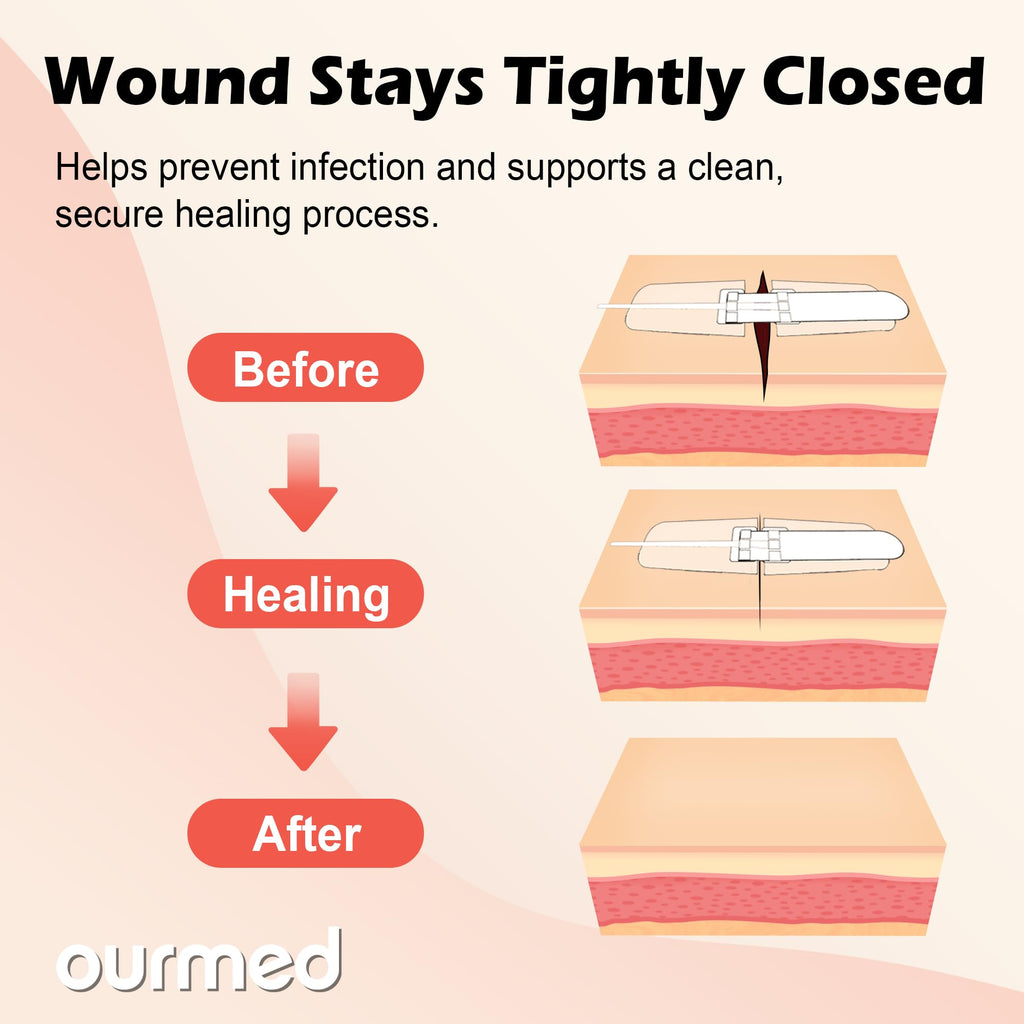 Ourmed Wound Closure Strips(0.6"x 3.1" - 4 Pcs), Butterfly Bandages for Wound Care, Steri Emergency Laceration Closures Without Stitches for Outdoors Use.