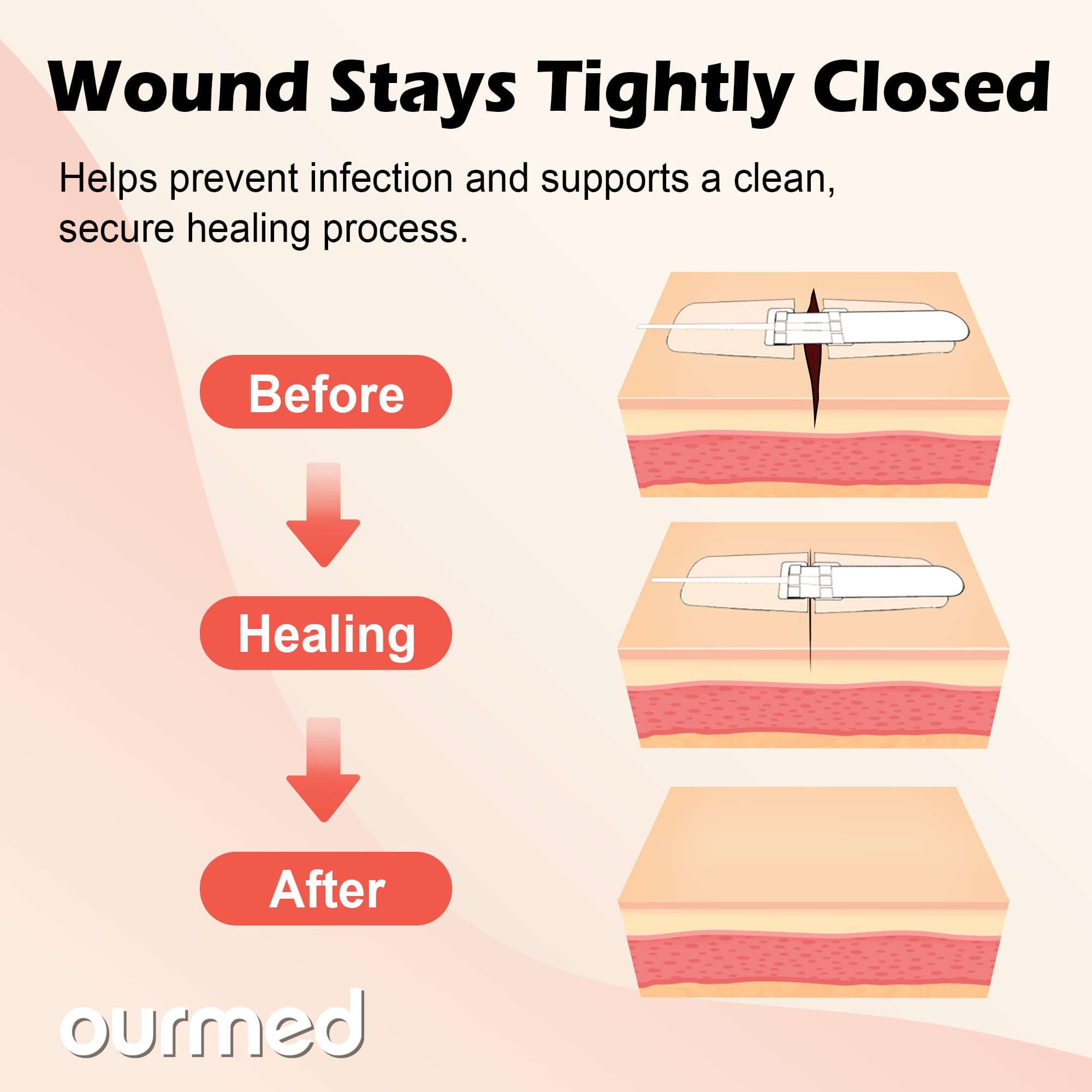 Ourmed Wound Closure Strips(0.6"x 3.1" - 4 Pcs), Butterfly Bandages for Wound Care, Steri Emergency Laceration Closures Without Stitches for Outdoors Use.