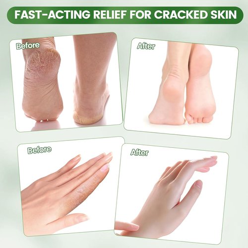 DooWee Aloe Vera Cracked Skin Patches - 50 Large Hydrating Bandages for Dry Heels & Hands | 3x2 Inch