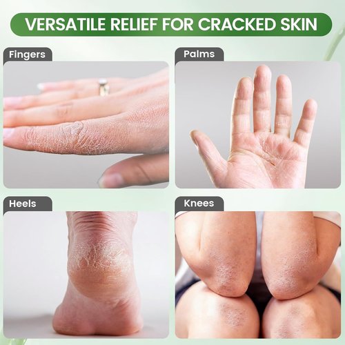 DooWee Aloe Vera Cracked Skin Patches - 50 Large Hydrating Bandages for Dry Heels & Hands | 3x2 Inch
