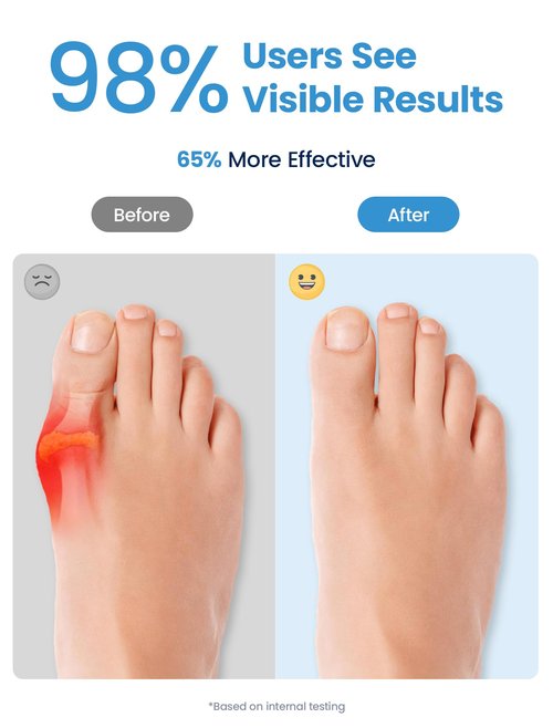 Habioer Bunion Corrector, Toe Separators for Women Men Big Toe, Toe Spacers, Bunion Correction, Breathable(4PCS)