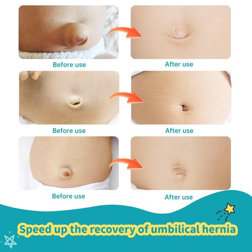 Lvyeyung Umbilical Hernia Belt Kit for Baby, Baby Belly Button Band, Hernia Belt with 4 Compression Pads and 3 Navel Patches, Infant Abdominal Binder Set, Umbilical Cord Cover for Newborn(S Pattern Green)