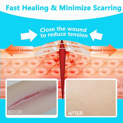 10PCS Wound Closure Strips, Butterfly Bandages Emergency Laceration Closure Kit Repair Wounds Without Stitches, Quick Clot Zip Stitch Wound Closures Device