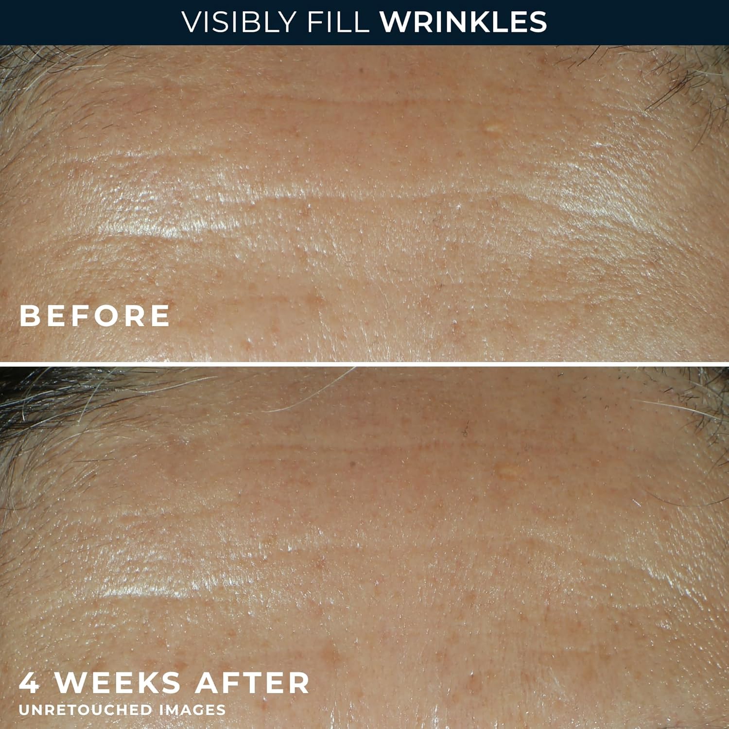 RoC Retinol Correxion Wrinkle Filler - Deep Wrinkle Treatment with Hyaluronic Acid, 1 Fl Oz