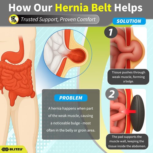 BLITZU Umbilical Hernia Belt for Men & Women, Abdominal Binder Adjustable Truss Support with 2 Compression Pads for Naval, Ventral, Incisional, Epigastric, Belly Button Hernias, Pre Post Surgery L-XL